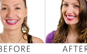 braces-before-and-after-promote-your-dental-practice-with-tiktok-Dental-Marketing-Heroes