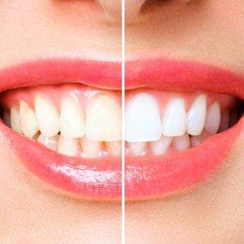 Teeth Whitening Services